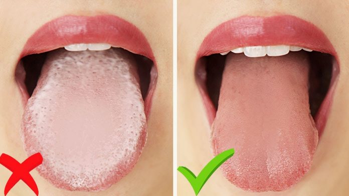 How to get rid of white tongue