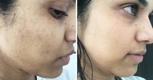 How to get rid of dark spots on face?